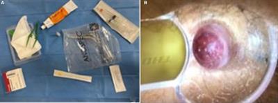 Sclerotherapy for III- and IV-degree hemorrhoids: Results of a prospective study